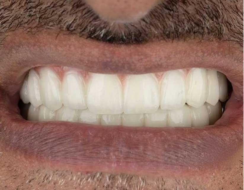 بعد از درمان