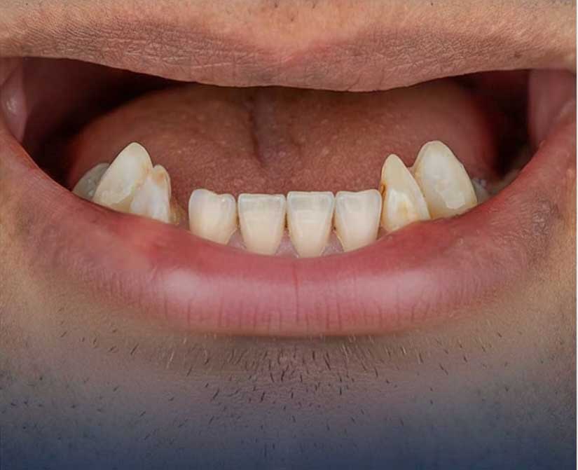 قبل از درمان