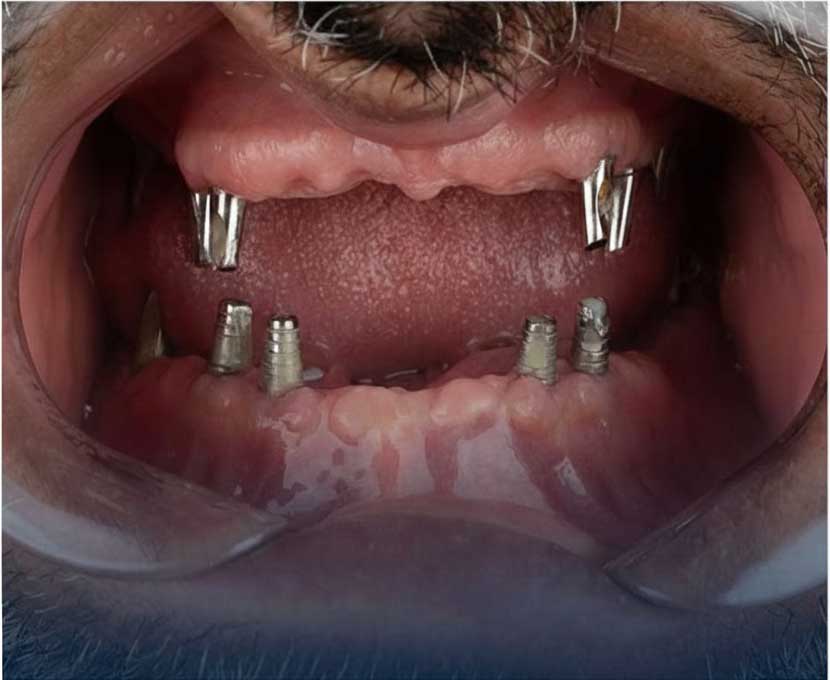 قبل از درمان